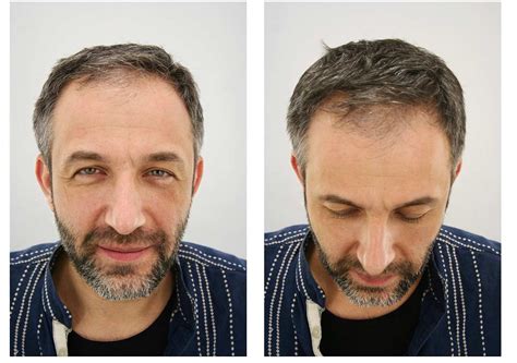 FKS Clinic - Hair Transplant in London and Istanbul